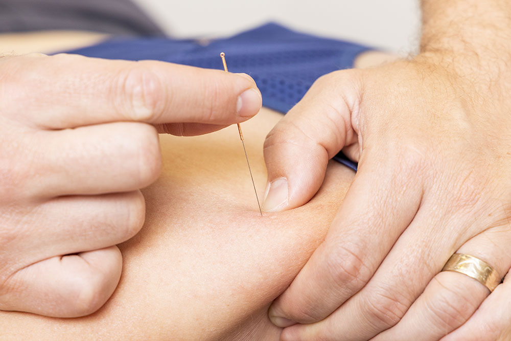 dry needling kinesist belsele